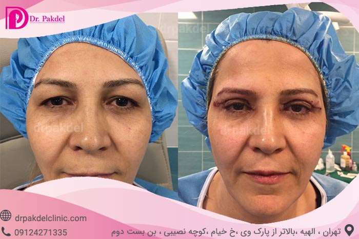 بلفاروپلاستی Blepharoplasty چیست؟ مزایا,مراقبتها