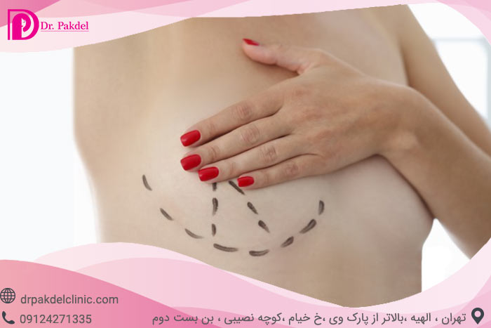 پروتز سینه چیست و چگونه انجام می شود؟ انواع پروتز سینه
