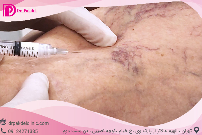 درمان واریس با اسکلروتراپی Sclerotherapy