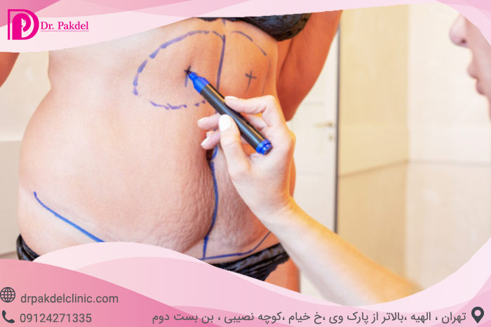 پیکرتراشی چیست و چگونه انجام می شود؟انواع روش ها