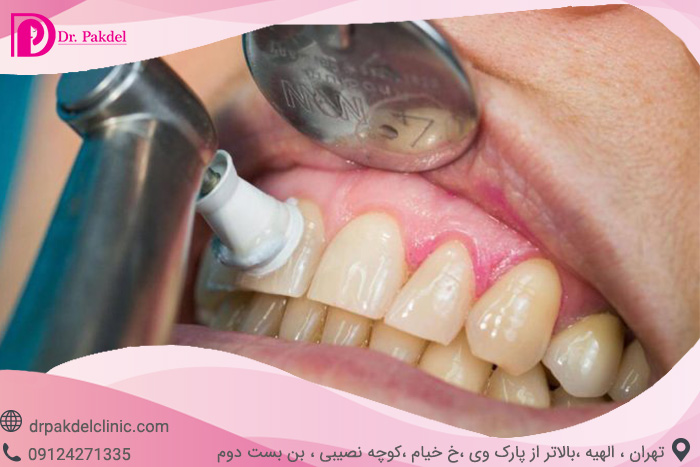 جرم گیری دندان چیست و چگونه انجام می شود؟