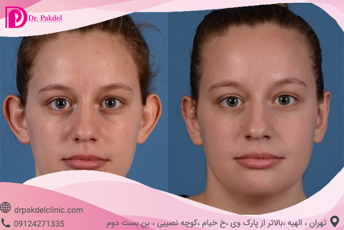 اتوپلاستی otoplasty یا جراحی زیبایی گوش چیست؟